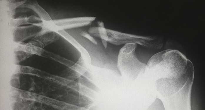 broken collarbone bone x-ray medical